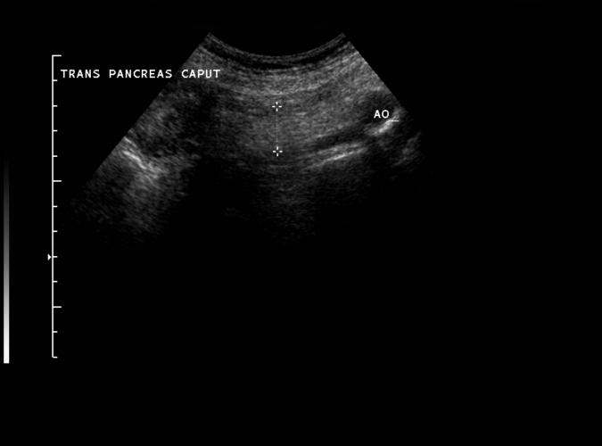 1a av Catherine Olsson, sonograf